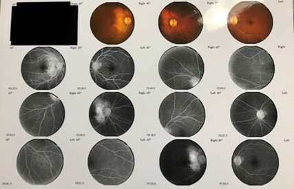 Fig. 3. Fluorescein Angiogram, OU